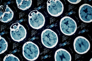 scans of damage to brain