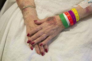 bruised arms of elderly woman in hospital
