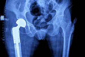 hip implant attorneys