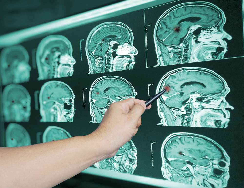 how-much-compensation-do-you-get-for-traumatic-brain-injury