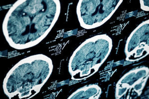Guide to Car Accident Head Injuries